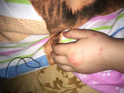 Руки ребенка с псориазом