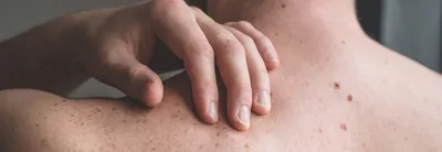 Картинка болячек на руках для исследования кожи
