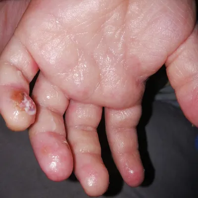 Фотография болячек на руках для медицинских целей
