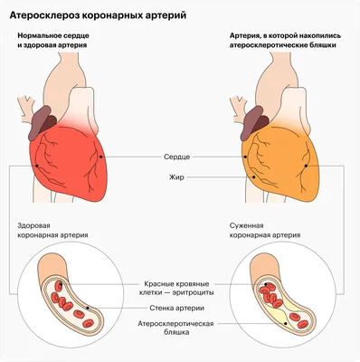 Почему болит сердце? — Семейная Клиника