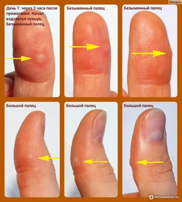 Бородавка на пальце руки: фото в разных форматах