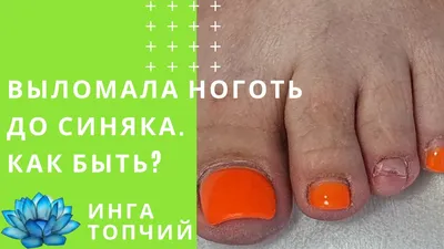 Бородавка на пальце руки: фото, которое заставит вас взглянуть повнимательнее