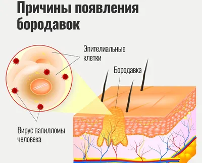 Фотография бородавки на пальце руки: макро съемка