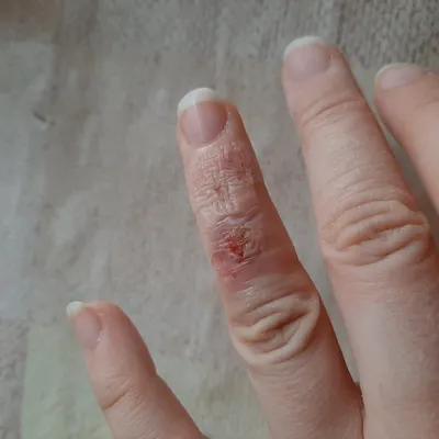 Бородавка на пальце руки: детальное фото