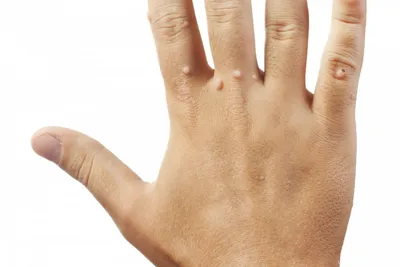 Фотографии бородавок на пальцах рук в формате PNG