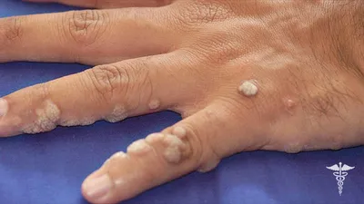 Картинки бородавок на пальцах рук: для лечения