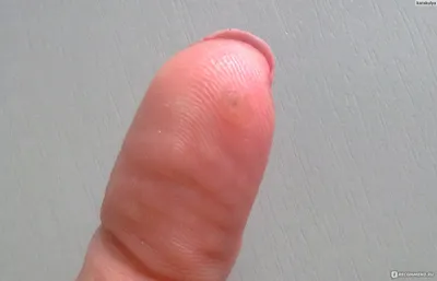Изображение бородавки на пальце руки в формате JPG