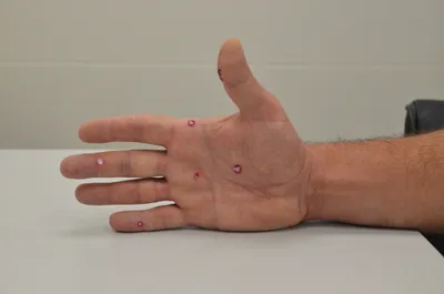Изображение бородавки на пальце руки с высоким качеством