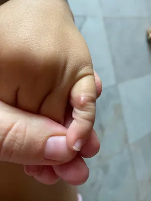 Изображение бородавки на пальце руки: как убрать дома