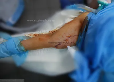 Брахиопластика подтяжка рук: фото результатов