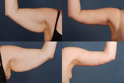 Изображение до и после брахиопластики подтяжки рук