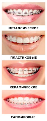 Брекет-система - шаг к красивой улыбке - интересно об ортодонтии,  имплантации и протезировании зубов