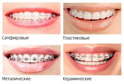 Чем отличаются лигатурные брекеты от безлигатурных | Ортодонт-центр  Ортодонтика, Москва