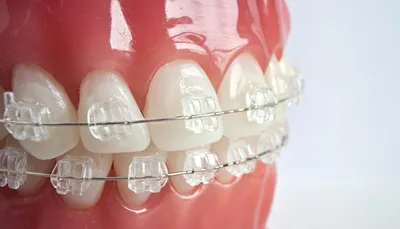 Что нужно знать про металлические брекеты - Cтоматологія Dentalknysh