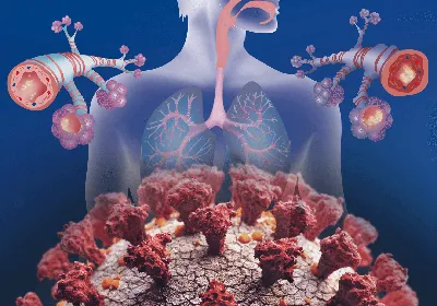 Как проявлется приступ бронхиальной астмы