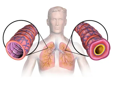 Бронхиальная астма – тема научной статьи по клинической медицине читайте  бесплатно текст научно-исследовательской работы в электронной библиотеке  КиберЛенинка