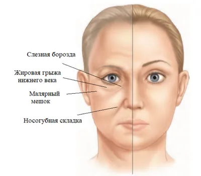 Лифтинг средней зоны лица в СПБ | Официальный сайт пластического хирурга в  СПб