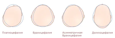 Фотография черепа новорожденного с эффектом боке