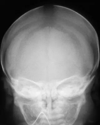 Фотография черепа новорожденного в PNG