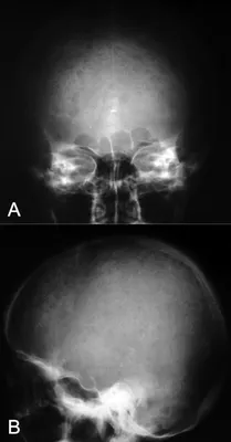 Изображение черепа новорожденного в черно-белом формате