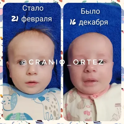 Деформация черепа у новорожденных фотографии