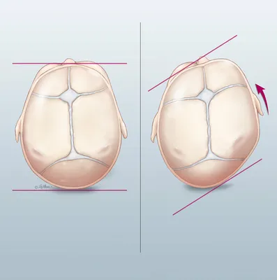 Фотка черепа новорожденного с деформацией