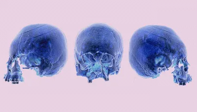 Изображение деформированного черепа у ребенка с врожденным пороком сердца