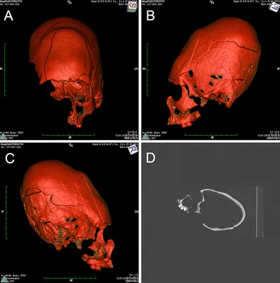 Изображение деформированного черепа у ребенка с гипоплазией мозжечка