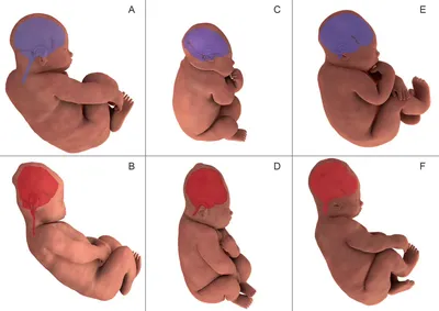 Изображение деформации черепа у ребенка в высоком разрешении