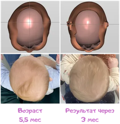 Картинка деформированного черепа у ребенка в формате PNG