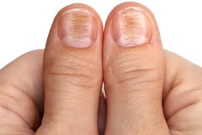 Основные причины деформации ногтей на руках: фото и объяснение