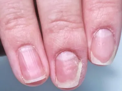 Как выглядят деформированные ногти на руках: фотографии для сравнения