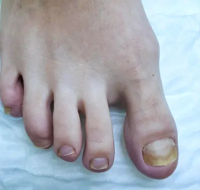 Фото-диагностика деформации ногтей на руках: как распознать проблему