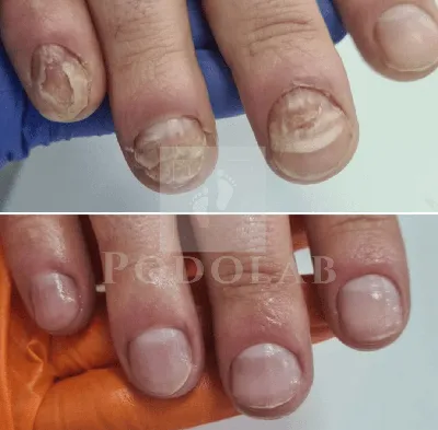 Какие заболевания могут привести к деформации ногтей на руках: фото-доказательства