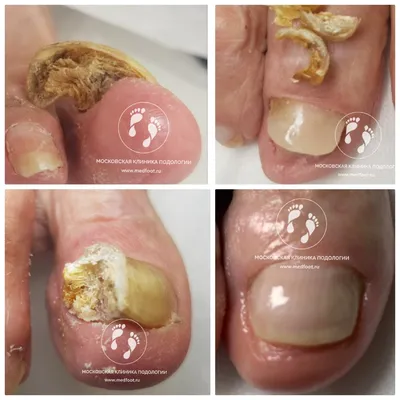 Фото-отчет о процедуре лечения деформации ногтей на руках