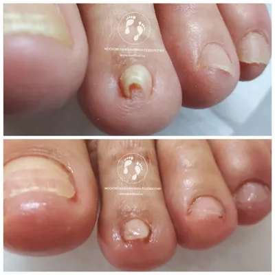 Деформация ногтей на руках у пожилых людей: фото-доказательства и возможности лечения