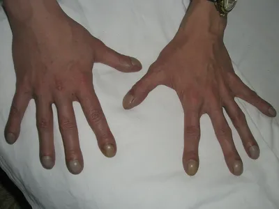Деформация пальцев рук фотографии