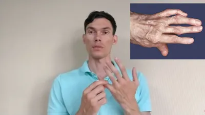 Фотография деформированных пальцев рук