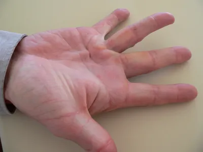 Фото с деформацией пальцев для анализа