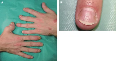 Деформация суставов пальцев рук фотографии