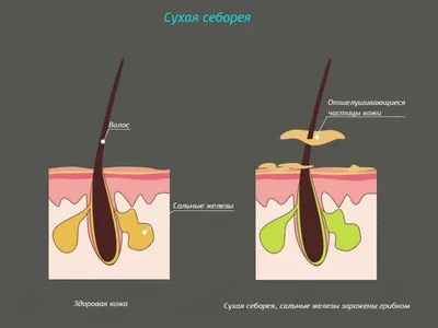 Фотографии демодекоза на руках для лечения