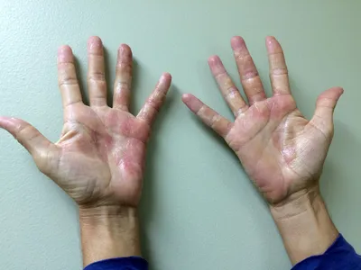 Фото дерматита кожи рук на фоне белого фона