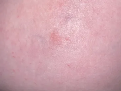 Фото дерматита кожи рук в натуральном свете