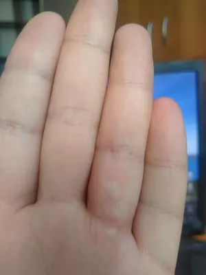 Картинка дерматита на пальцах рук: из ближайшего ракурса