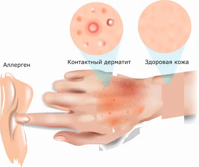 Изображение дерматита на пальцах рук: JPG формат