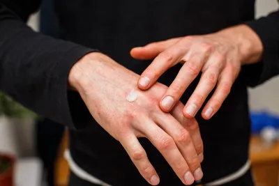 Фотографии дерматита на пальцах рук: как избежать