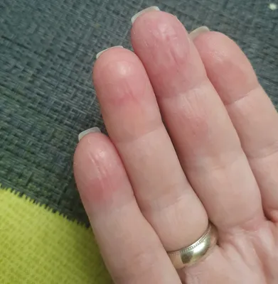 Фото дерматита на пальцах рук: скачать в JPG формате