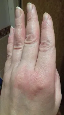Изображение дерматита на руках у ребенка для лечения
