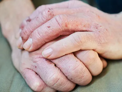 Изображение рук с дерматитом в PNG