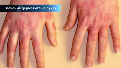 Фотография рук с дерматитом в PNG
